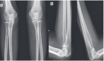 Figure 1: Images of X-ray, right and left elbow: The direct preoperation radiographies showed no significant changes or calcification (9/5/16).