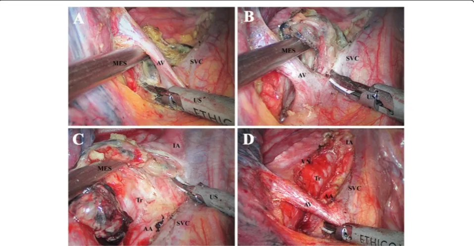 Figure 2 Dissection of station 7 from the right side. (A)LMB Dissecting the block off the esophagus