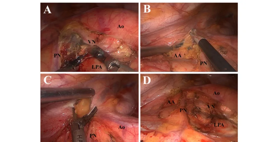 Figure 3 Dissection of station 5 and 6. (A) Dissecting the block of station 5 anterior to the vagus nerve and posterior to the phrenic nerve.(B) Opening the mediastinal pleura anterior to the phrenic nerve