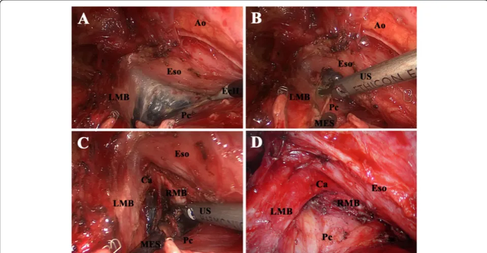 Figure 4 Dissection of station 4 L. (A)USleft main-stem bronchus. Dissecting the block off the arch of aorta