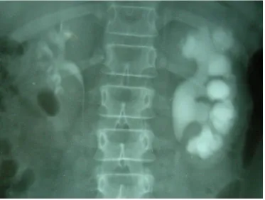 Figure 2 - IVU Showing Lt PUJO