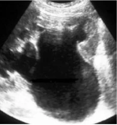 Figure 3 - USG Showing Lt HN