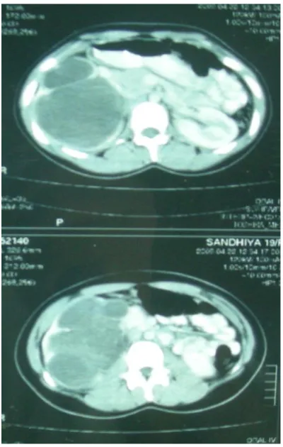 Figure 4 - Rt PUJO with thinned out Cortex
