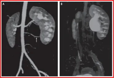 Figure 8 - Gadodiamide enhanced MRU shows mild Lt