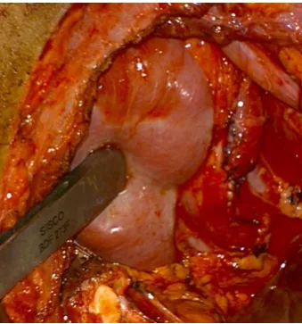 Figure 12 - Open Pyeloplasty