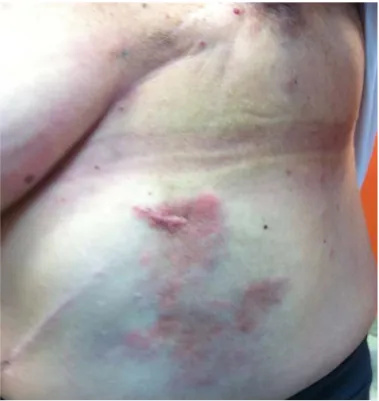 Figure 2. Cutaneous metastatic lesions at basal. 