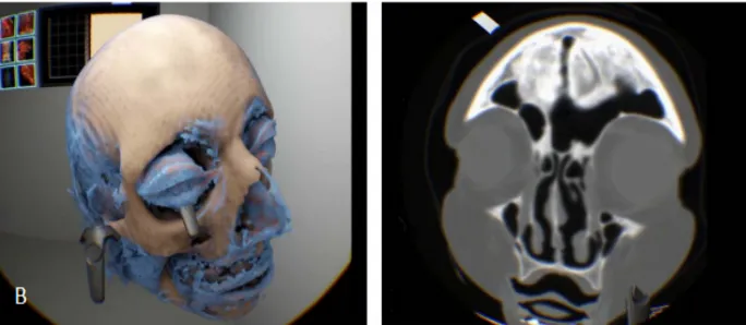 Fig. 12.  “Stereoscopic illustration of the VR environment displaying volume OCT data of a pe-ripheral retinal tear” [15] 