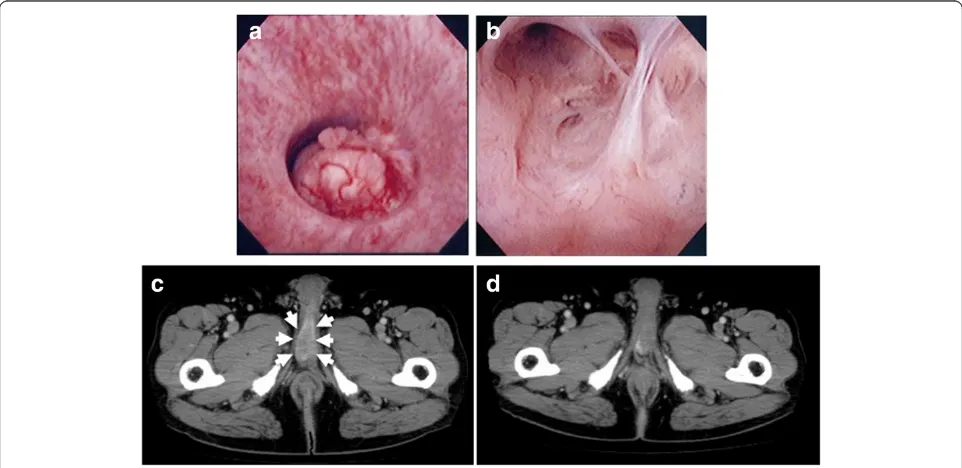 Figure 1 Urethral tumor detected four years after sigmoidectomy. (a)recurrence of the tumor