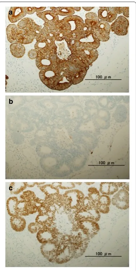 Figure 3 Immunohistochemical staining of urethral tumorusing an anticytokeratin antibody, (a) CK20 and (b) CK7(original magnification, ×20), and using an antibody againstthe intestinal epithelia-specific nuclear transcription factor,(c) CDX2 (original magn