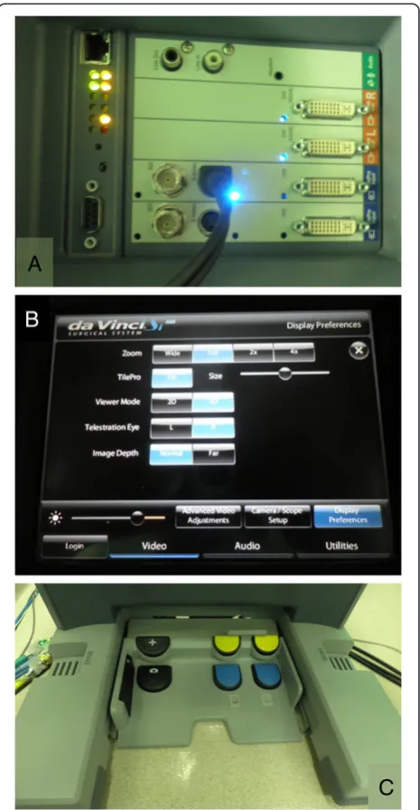 Figure 1 Tilpro™ set up. (A) The posterior view of the da VinciSurgical System input device for endoscopic video output