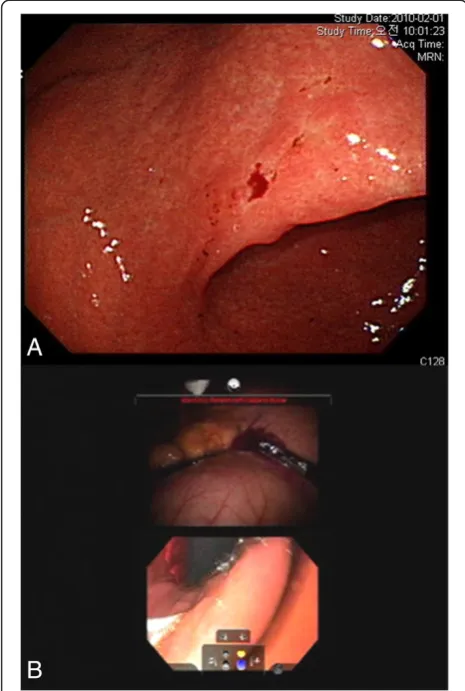 Figure 3 Preoperative upper endoscopy and multi-input viewof intraoperative upper endoscopy
