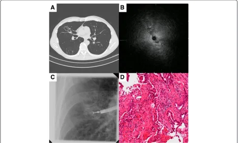 Fig. 3 Case of a 64-year-old man with an abnormal shadow in the right middle lobe. (biopsy through a guide sheath
