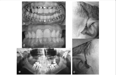 Table 6 Post-operative complications after surgicaltreatment of condylar fractures