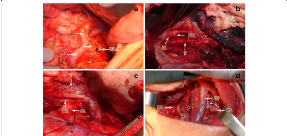Figure 1 Lymphadenectomy for esophageal carcinoma. (a) Upper abdominal field. CA: celiac artery, CHA: common hepatic artery, SA: splenicartery, LGA: left gastric artery