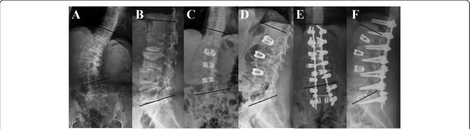 Figure 1 A 64-year-old woman complained low back pain with bilateral sciatica and claudication for several years.posterior instrumentation of T12-S1 with posterior interbody fusion of L5-S1 was performed