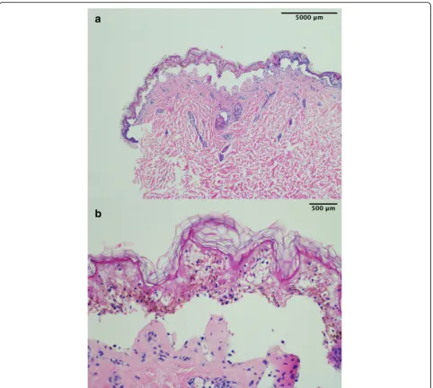 Fig. 3 Histological findings from skin biopsy. a Low-power image showing sub-epidermal splitting