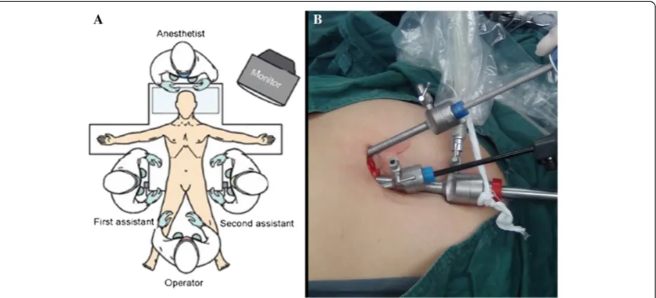 Figure 1 Operating room setting and access site in the umbilicus. (A) Operating room setting: the operator, assistants and monitor.(B) Access site in the umbilicus: the two trocars for the lens, grasper, and the plastic disposable trocar, for the ultrasonic scalpel.