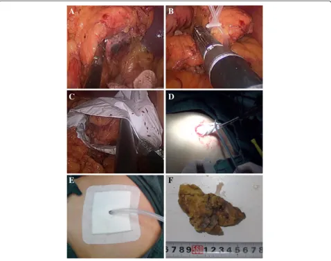 Figure 2 Operative procedure of laparoscopic distal pancreatectomy. (A) Exposure of pancreas