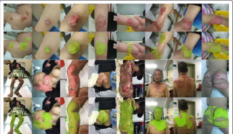 Fig. 8 Segmentation results of different burn wounds sizes. The first and second rows show the %TBSAresults of R101FA
