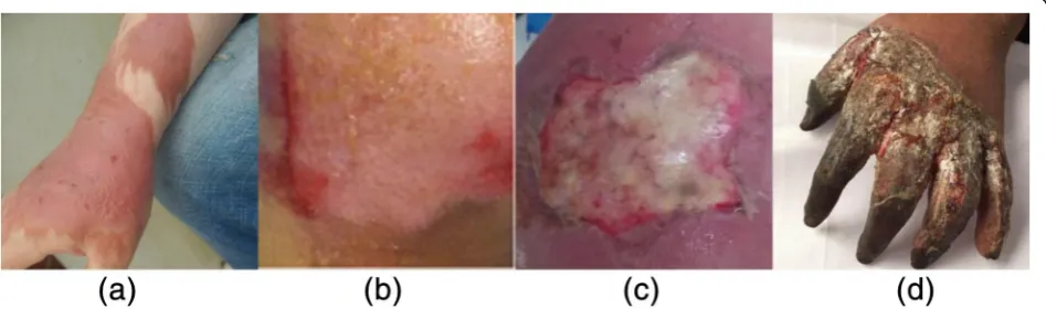 Fig. 7 a–d Different burn depth. From left to right is superficial, superficial thickness, deep partial thickness, and full-thickness burn