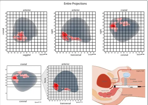 Figure 1 HistoScanning report and perineal biopsy setting PHS analysis provides a transversal slice report of the unique prostate showingsuspicious areas with a spatial resolution of 5 mm
