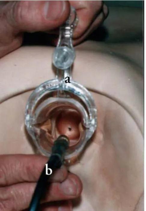 Figure 4Clockwork light source speculum in use (simulation model) 