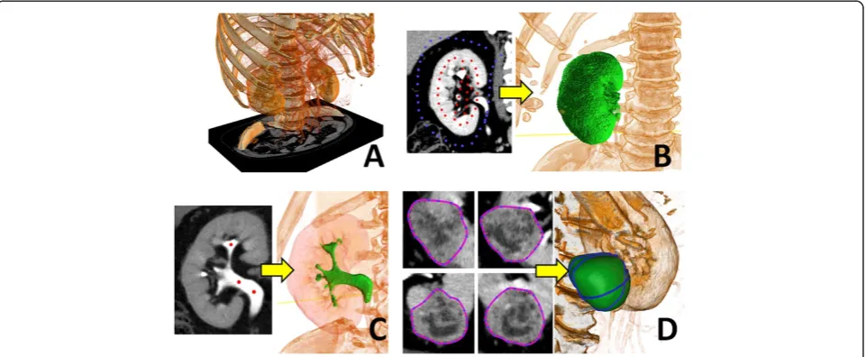 Figure 1 Segmentation of CT image. From an input 3D CT image (A), we segmented the three regions by different methods