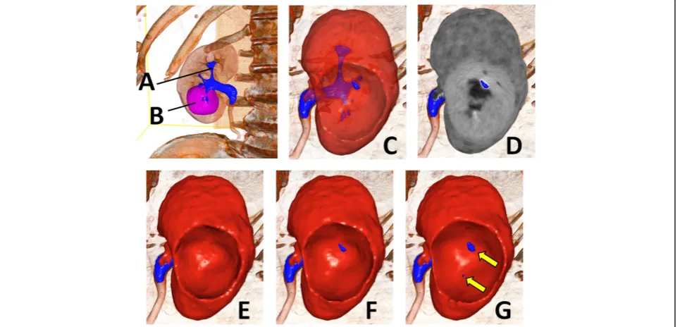 Table 1 summarizes the backgrounds of the patients,prediction results, and surgical outcomes
