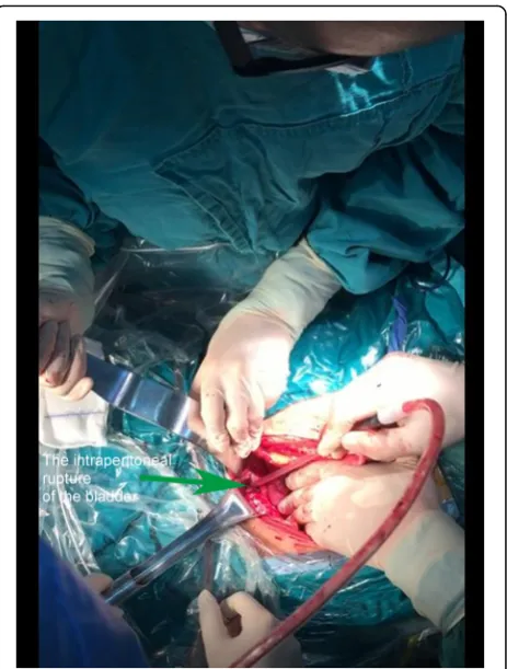 Fig. 1 Surgical observation. Intraperitoneal rupture of the bladderwas observed, and the breach was irregular