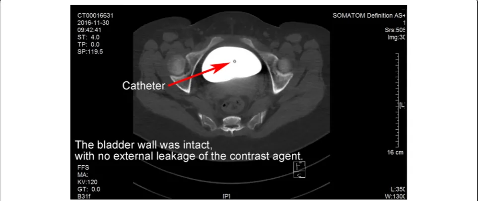 Fig. 2 Pathological diagnosis: (bladder). The transitional epithelium under the mucosal lining of bladder tissue
