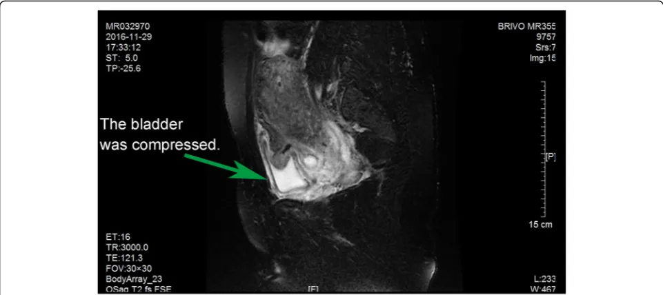 Fig. 5 Pelvic MR in the coronal position. The apex of bladder was rough and had wrinkle-like morphology