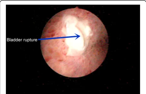 Fig. 6 Cystoscopy. The apex of bladder was observed to beruptured. The rupture was fissure-like, with pale ischemic necrosis inthe peripheral tissues