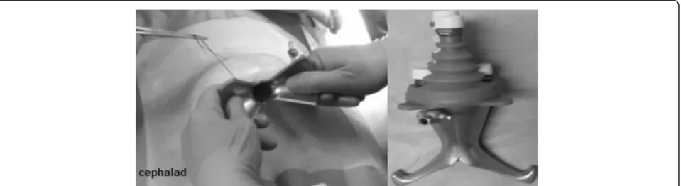 Figure 1 Transumbilical introduction of the two single port half shells (left). X-Cone fully assembled with a reusable silicone cap, providing5 working channels (right).