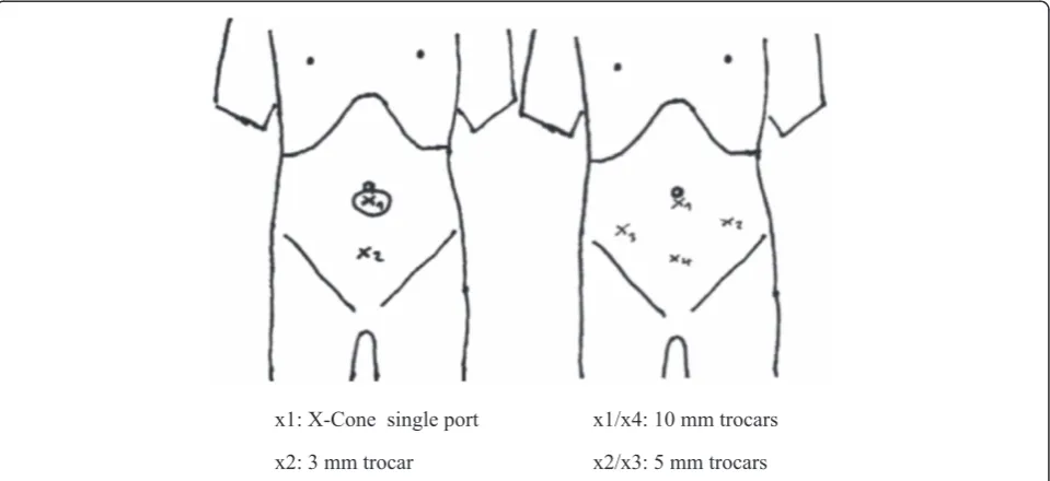 Figure 2 Trocar placement in LESSPL (left) and multiport PL (right).