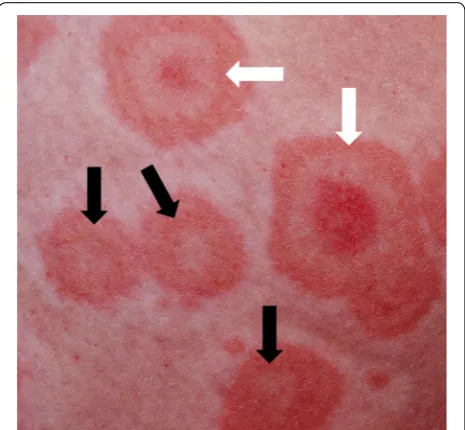 Fig. 1 Erythema multiforme (photo reproduced with permission of Gary White, MD): typical target lesions (white arrows) together with atypical two‑zoned lesions (black arrows)