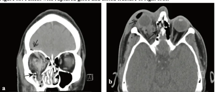 Figure S3. Patient with ruptured globe and closed fracture of right orbit 
