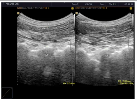 Figure 1 Ultrasound image of resting LMM (left image) contracted LMM (right image). Calipers placed on the apex of facet joint of L4, andon the interface between the thoracolumbar fascia and subcutaneous fat.