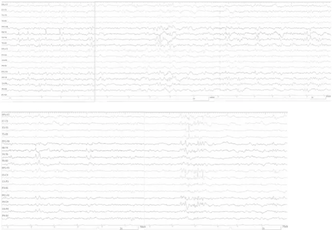 Figure 1: Interictal EEG pattern of the patient.