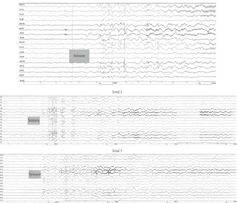 Figure 2: Ictal EEG pattern of the patient during three-seizure attacks.