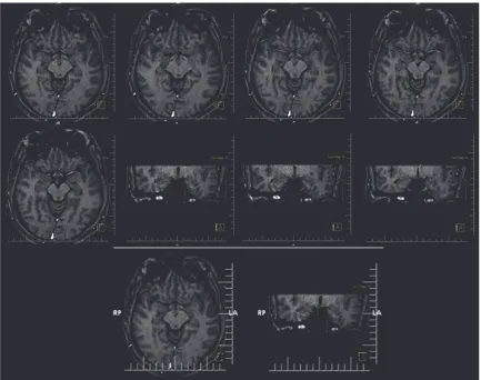 Figure 3: MRI of the patient revealing hypothalamic hamartoma.