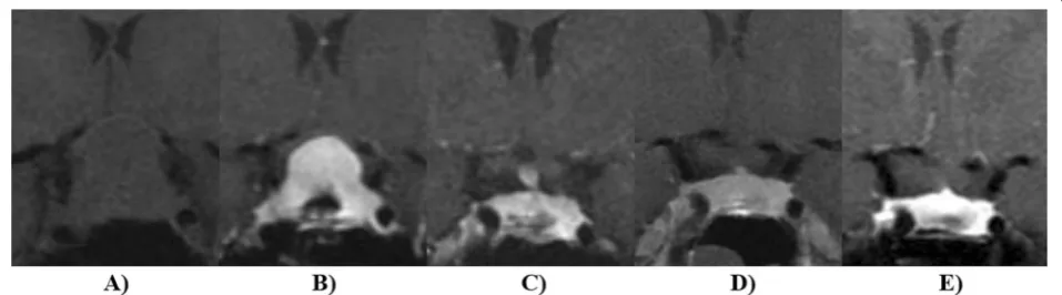 Fig. 1 Hypophysitis was diagnosed in a 30 year old during the late third trimester of pregnancy