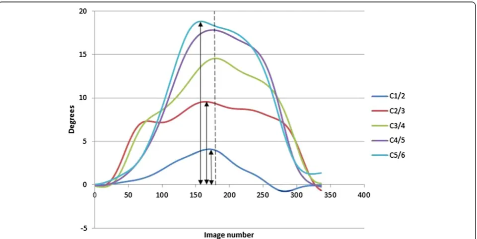 Figure 3 Examples of IV-RoM compared to global motion. IV-RoMs at individual levels are shown as peaks of coloured lines and the end ofglobal motion as a dotted line.