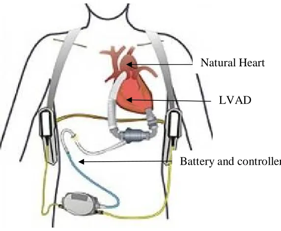 Figure 1: Implanted LVAD demonstration [3]. 
