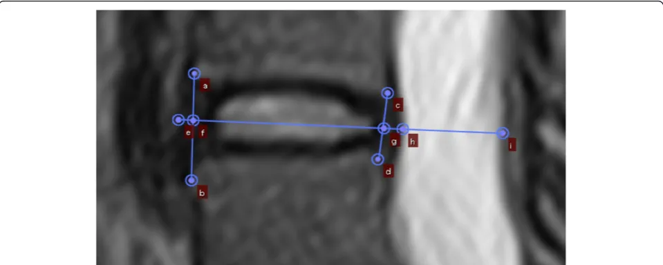 Figure 1 Positioning of measured structures (a-i); (a-b) Anterior intervertebral height; (c-d) Posterior intervertebral height; (e-f)Anterior disc material; (f-g) Intervertebral disc; (g-h) Posterior disc material; (h-i) Dural sac.