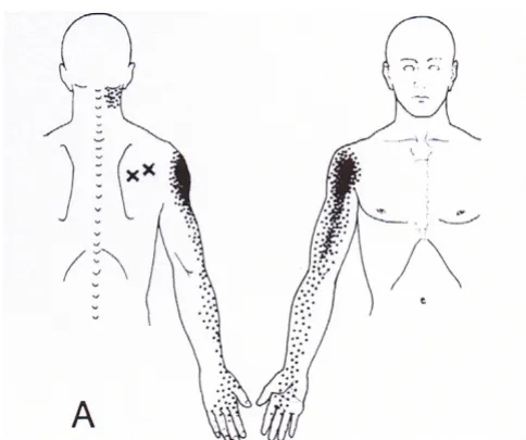 Figure 1Upper Extremity DermatomesUpper Extremity Dermatomes. (Permission granted by PILs licensing to use figure – Diagram source copyright EMIS and PiP 2006)