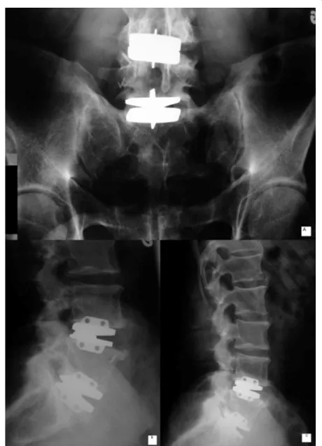 Figure 1 Metal-on-metal disc prosthesis at L4-L5 and L5-S1. a) an-tero-posterior radiograph, b) and c) lateral view.