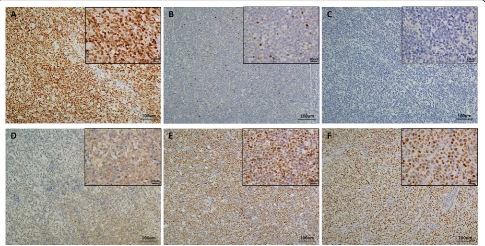 Fig. 2 P63 expression in EBV+ DLBCL.was a HE staining of EBV+ DLBCL. b EBV in situ hybridization showed positive results