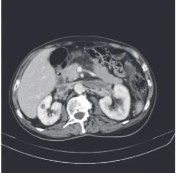 Figure 2: CT scan cross section: anterior mediastinal mass, upperquadrant, with irregular shape, heterogenous iodophilia; it has smallareas of necrosis; axial dimension approx 49/29 mm and 50 mmcraniocaudal; it is situated between the ascendant aorta and thetrunk of the pulmonary artery and has lateral relation with thepulmonary parenchyma.