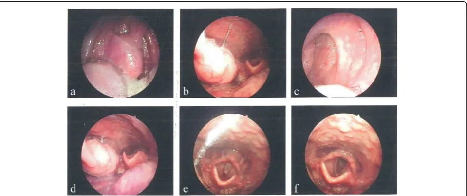 Fig. 1 Laryngoscopy results. a-f Images of endoscopy findings showing tonsillar hypertrophy (right, grade 3; left, grade 2); an elongated uvula;and posterior pharyngeal wall lymphoid hyperplasia
