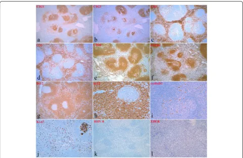 Fig. 3 Immunohistochemical (IHC) features and in situ hybridization (ISH) results. a and b (5×, IHC): Follicular dendritic cells stained with CD21and CD23 antibodies